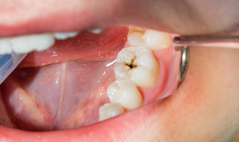 روش های درمان پوسيدگی دندان و مراحل پوسیدگی دندان ها